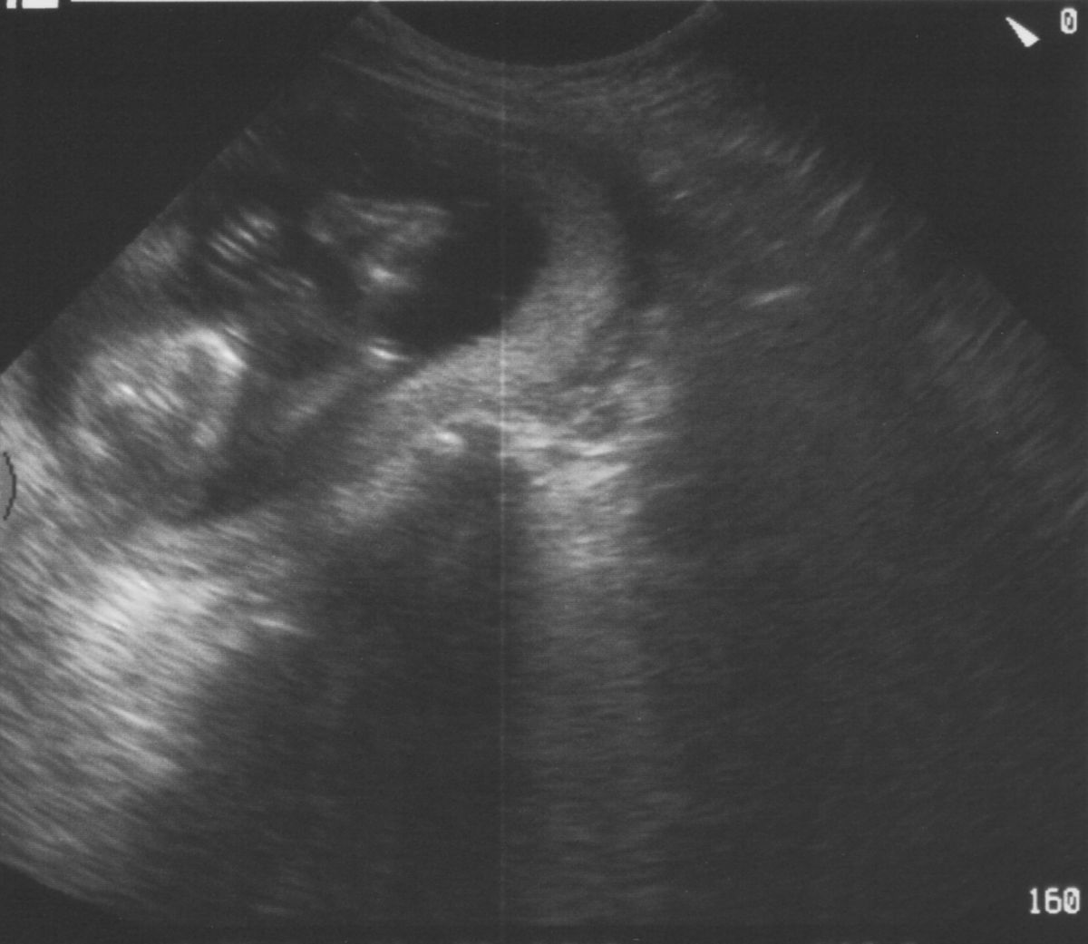 Ultraschall - 16. SSW