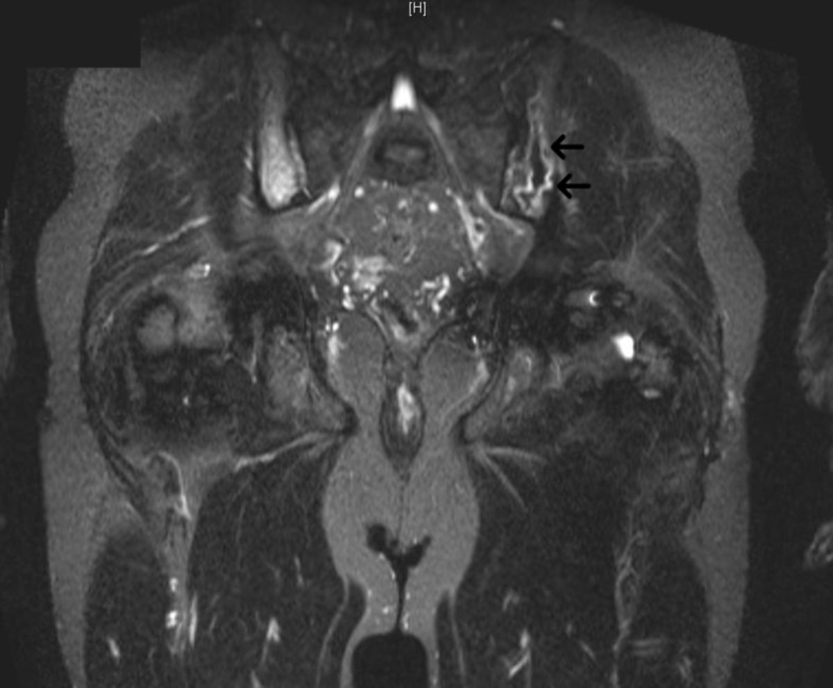 Knocheninfarkt bei Morbus Gaucher (MRT)