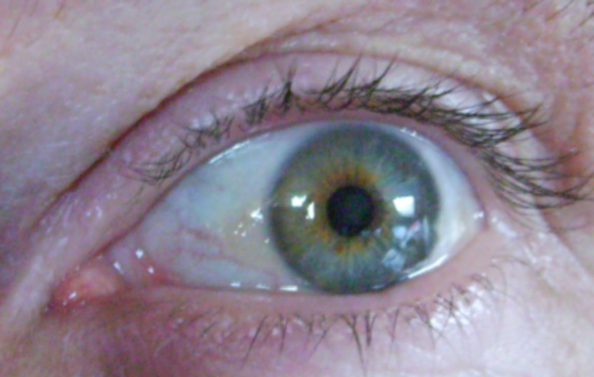 Pinguecula